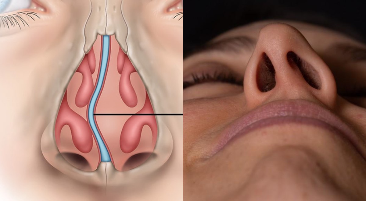 Septum Deviasyonu