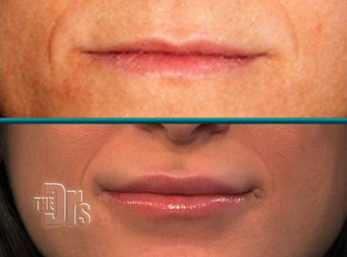 doctors-lip-augmentation-ba.jpg