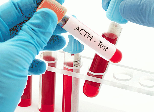 ACTH Nedir Normal Değerleri Kaç Olmalıdır?