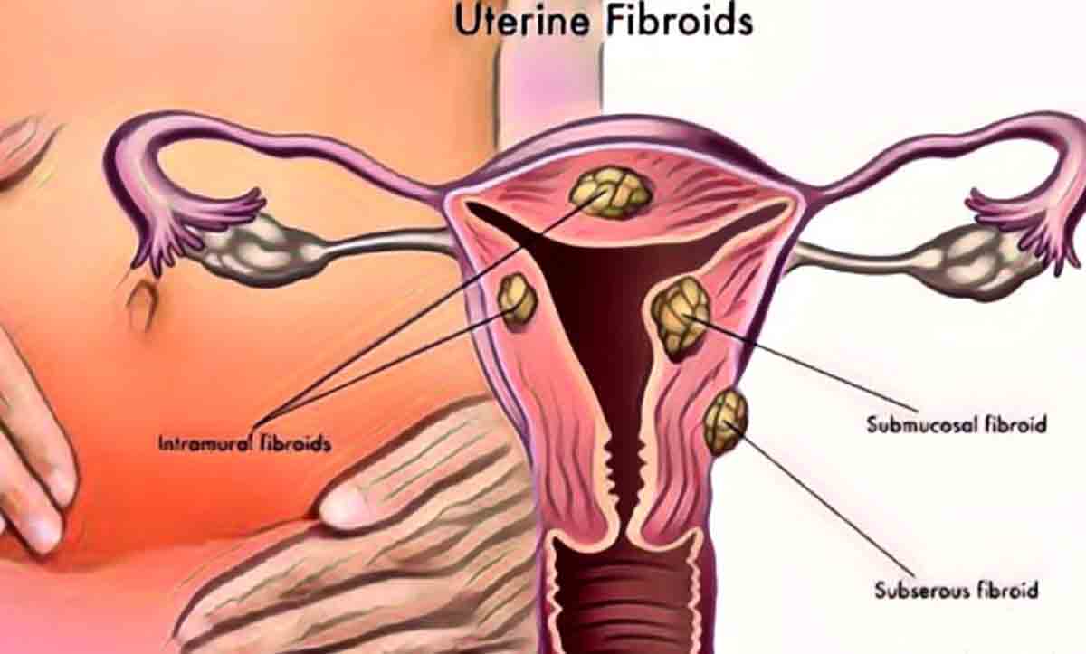 miyom çeşitleri fibroid